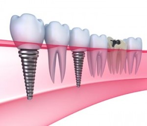 dental-implants-illustration1