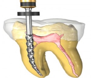 root canal treatment in Reading